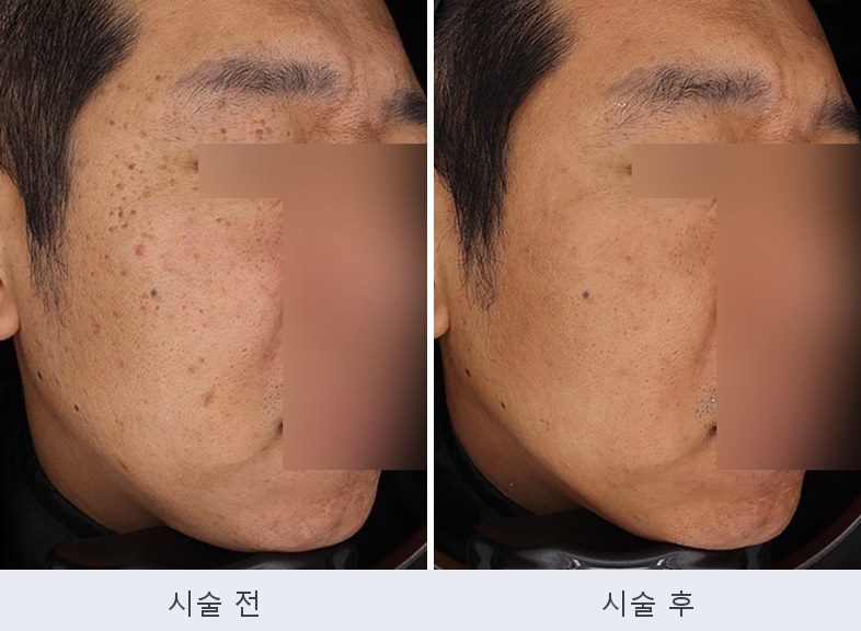 기미 주근깨 잡티